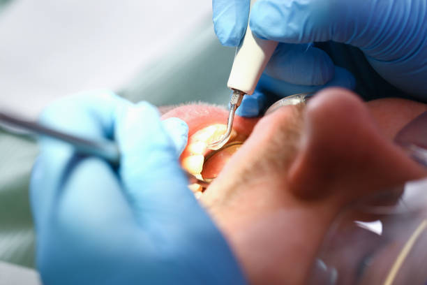 Best Emergency Tooth Extraction in Kirbyville, TX